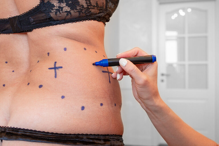 ดูดไขมันเฉพาะจุด